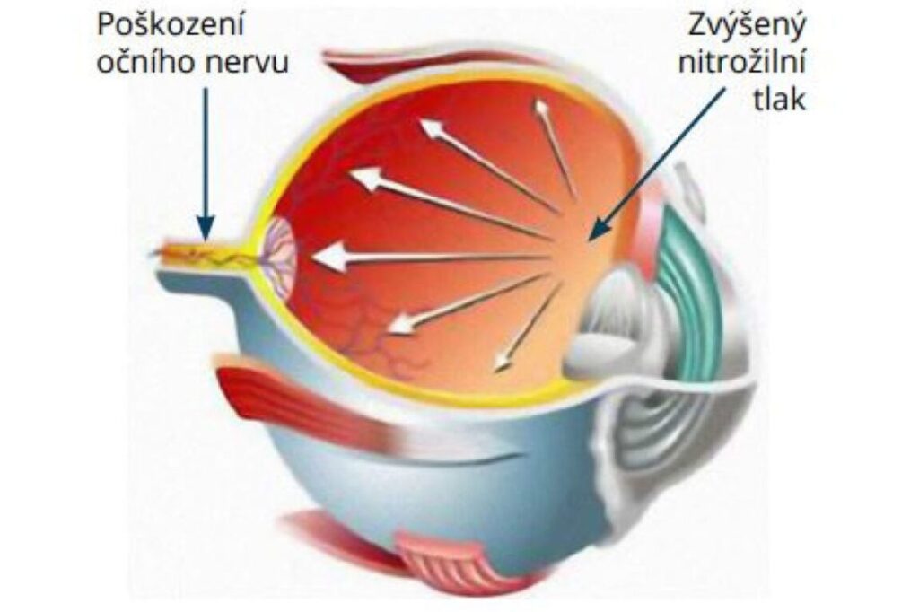 Prevention and treatment of glacoma featured image